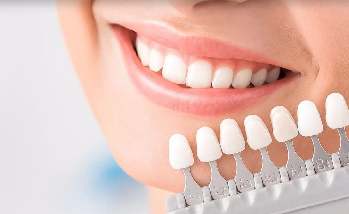 Facettes esthétiques